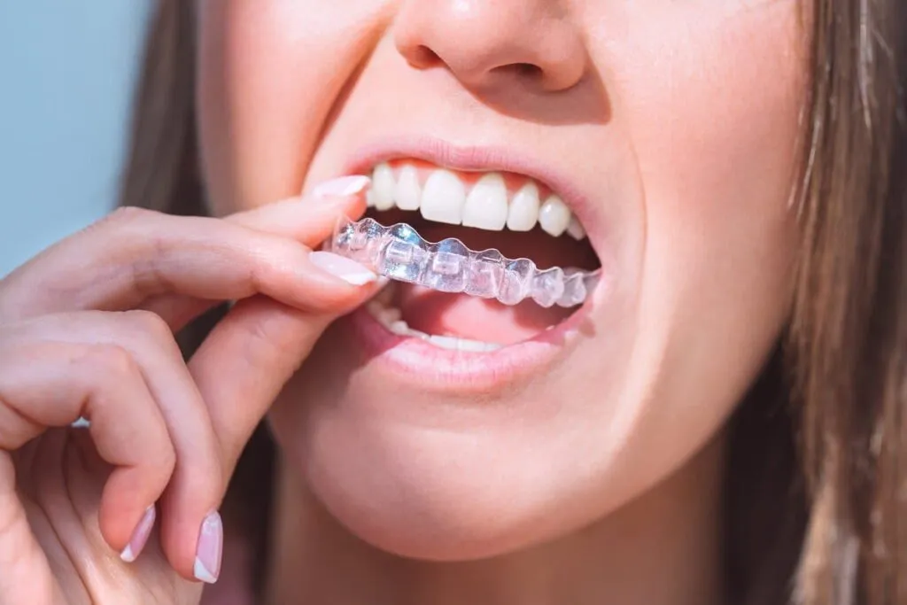 Woman with perfect smile inserting invisible dental aligners for dental correction