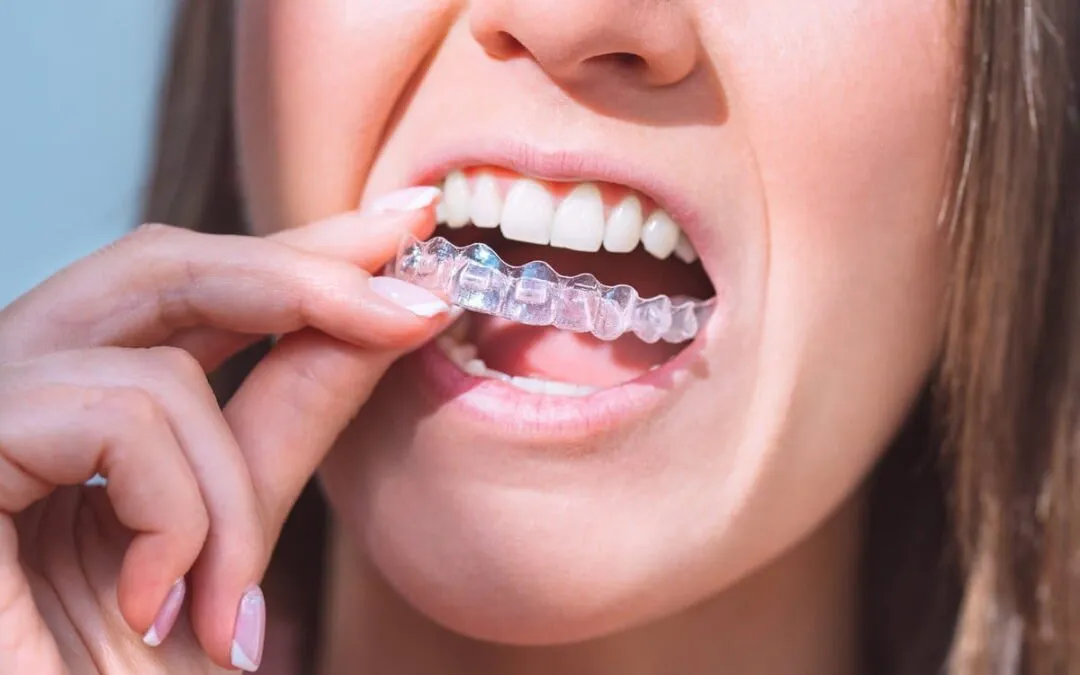 How Invisalign Can Transform Your Smile Before Summer Ends