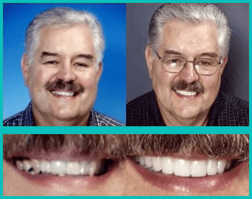 Before and after case study of dental work.