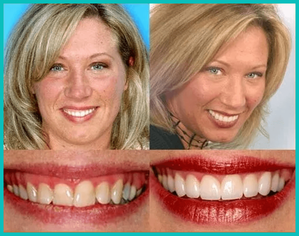 Before and after case study of dental work.