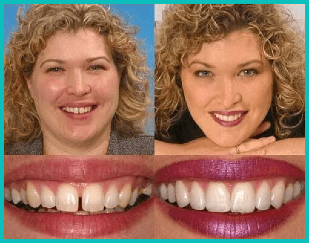Before and after case study of dental work.