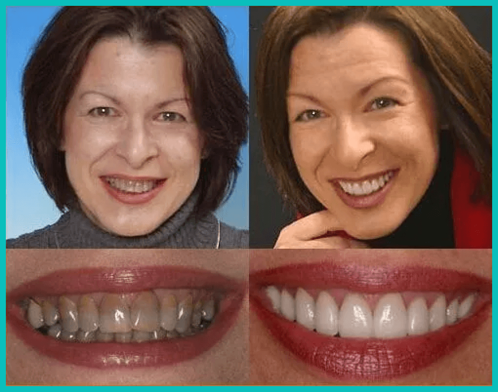 Before and after case study of dental work.