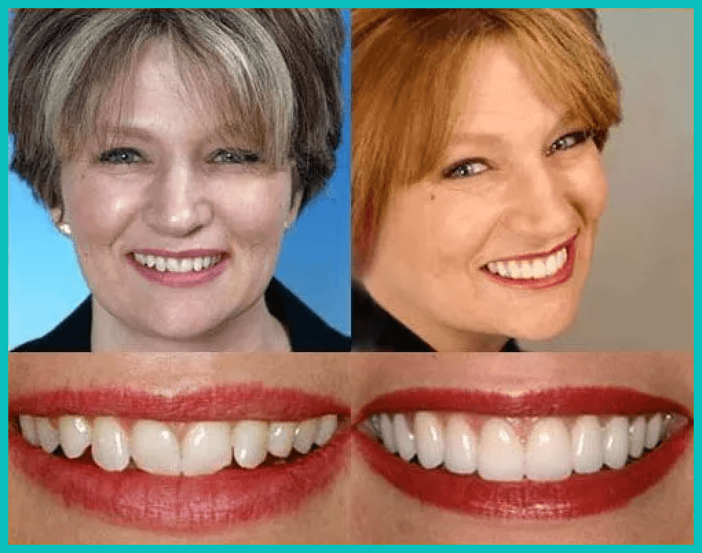 Before and after case study of dental work.