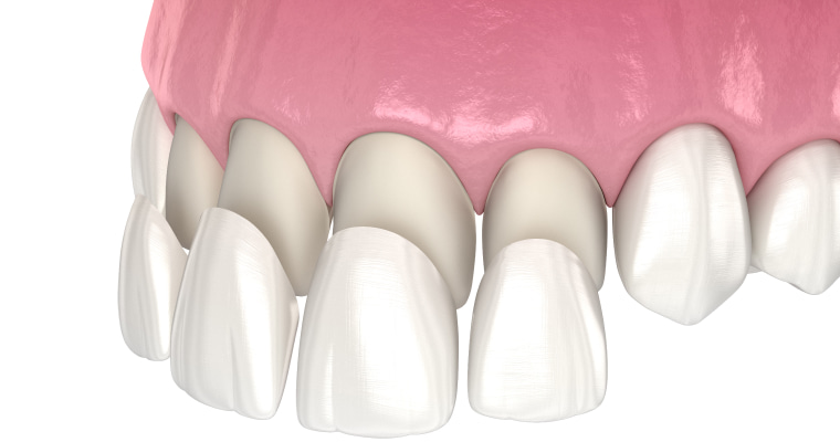 Composite Veneers vs. Porcelain Veneers: Choosing the Right Dental Solution