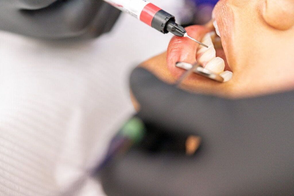 Dentist applying a metal-free composite filling to a patient's tooth