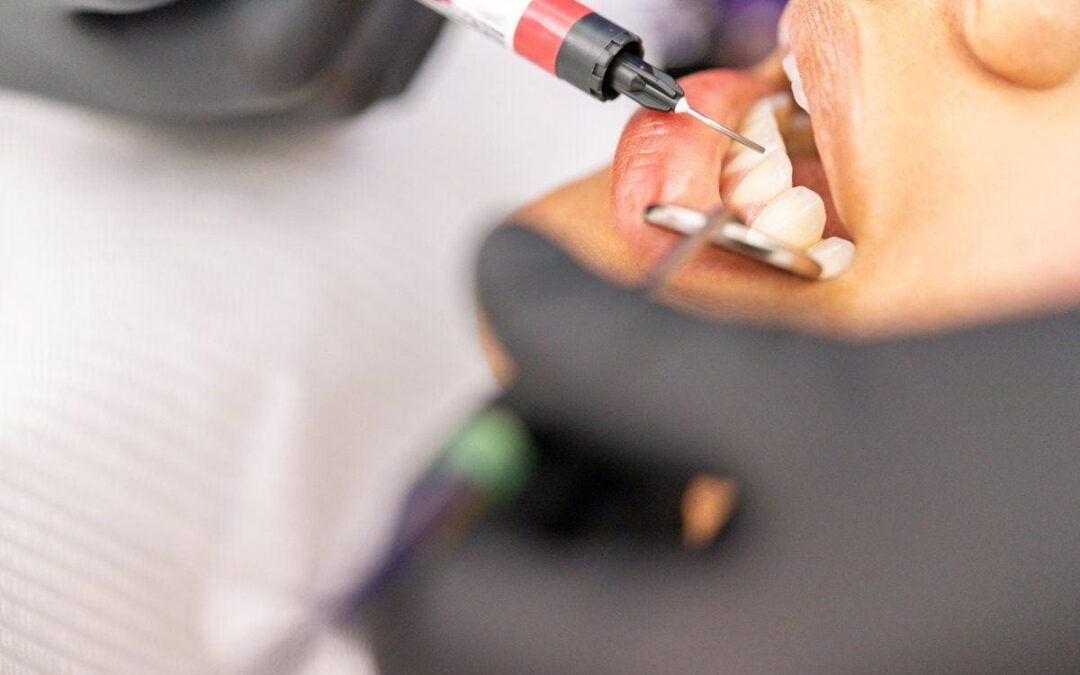 What Is a Metal-Free Filling and Is It Right for You?